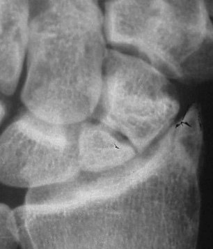scaphoid_fig2a