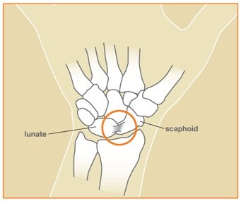 Wristsprains_image2