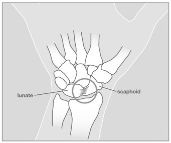 Wristsprains_image2